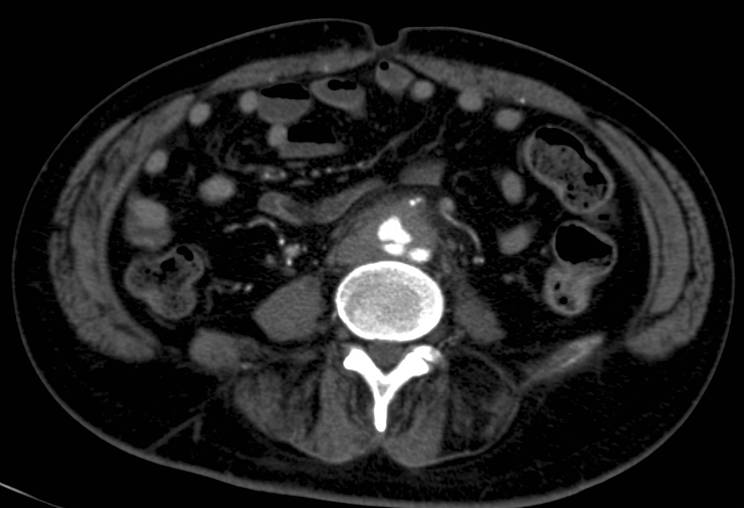 M/61, C.C.: Abdominal Pain, Fever (since 2WA ago)